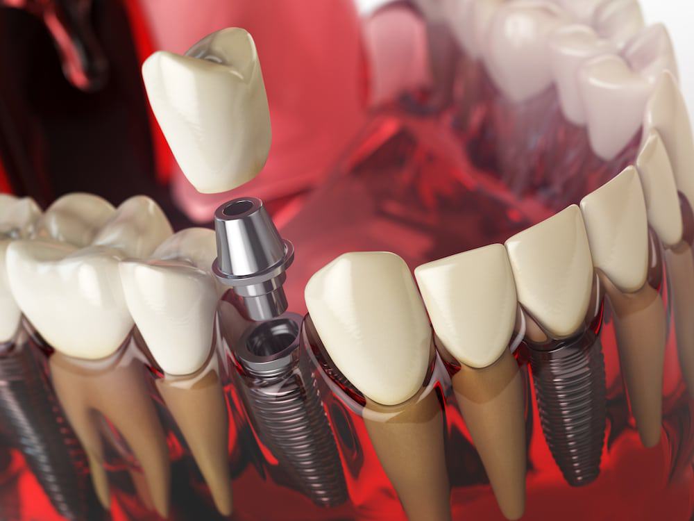 Dental Reconstruction 2 dentist Virginia Beach, dentist Norfolk
